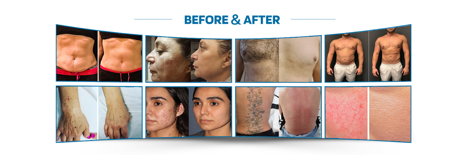 chất lượng máy tẩy lông bằng laser nhà máy sản xuất