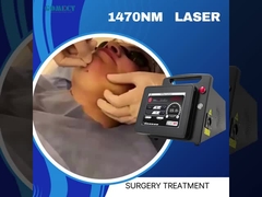 Endolaser 1470 Lifting Lipolysis Mặt Xóa tĩnh mạch nội tĩnh mạch Laser Spider Vein